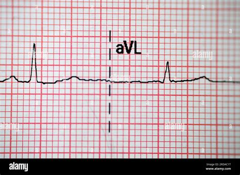 Electrocardiographic T Wave Abnormalities and the Risk of .